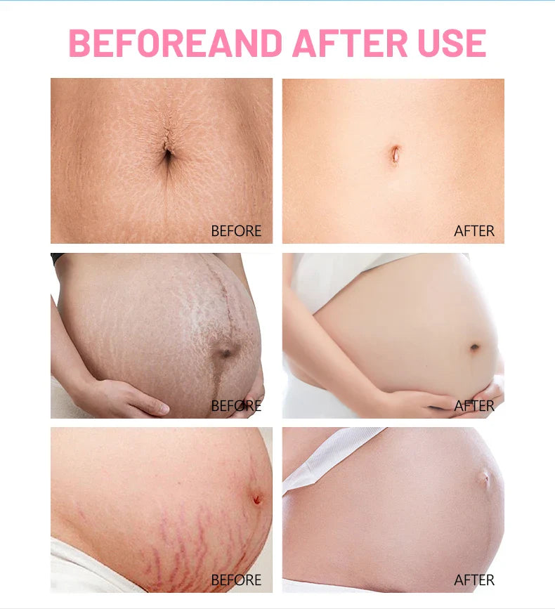 Anti Stretch Mark Cream ( Original )