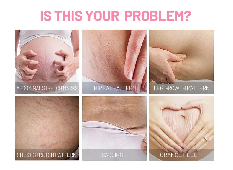 Anti Stretch Mark Cream ( Original )